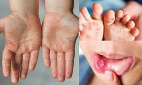 Cảnh báo bệnh tay chân miệng và sốt xuất huyết tiếp tục gia tăng, nhiều ca nặng