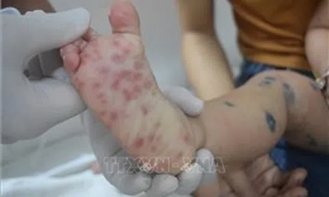 Tăng cường công tác truyền thông, kiểm soát bệnh tay chân miệng