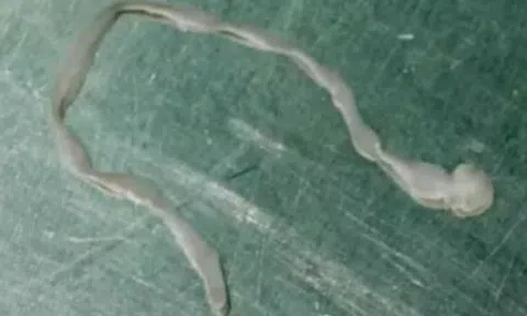 Người phụ nữ lên cơn co giật, bác sĩ lấy ra thứ đáng sợ trong não