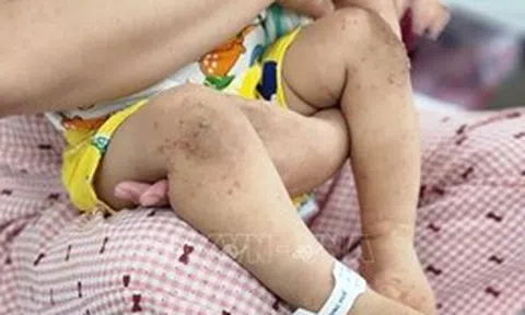 Số trẻ mắc bệnh tay chân miệng tăng gấp 3,5 lần so với cùng kỳ năm trước