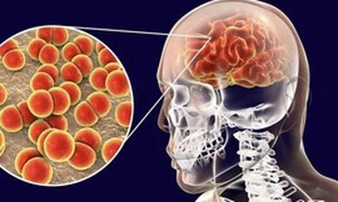 Ca bệnh do não mô cầu gia tăng