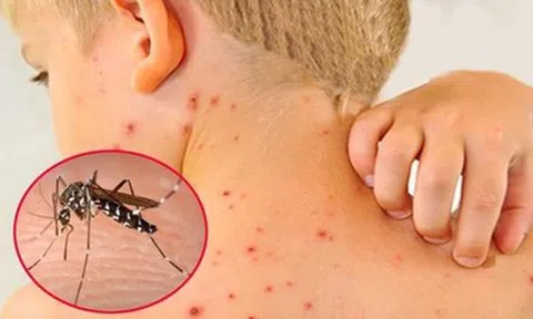Dịch sốt xuất huyết tăng cao, chuyên gia cảnh báo biến chứng nặng của bệnh