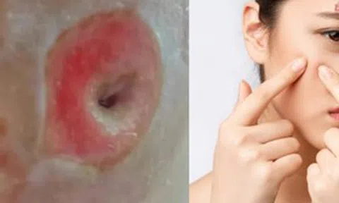 Người phụ nữ 40 tuổi chết lặng khi thấy mặt như "tổ ong" vì sai lầm ai cũng dễ mắc