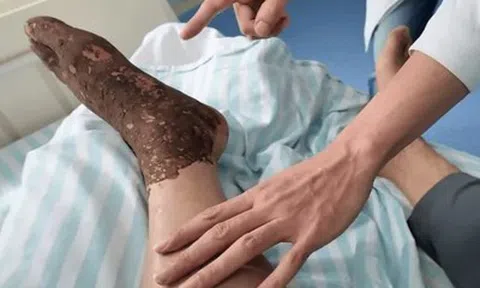 Bị rắn độc cắn khi đang cấy lúa, người đàn ông làm 1 việc khiến bác sĩ khen ngợi