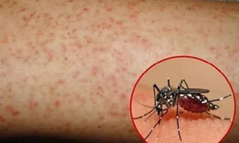 Sốt xuất huyết Dengue: Thay đổi khó lường, lan rộng và phức tạp hơn