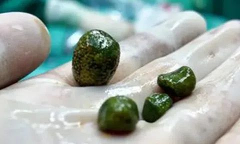 Cô gái 28 tuổi "sốc" khi bác sĩ gắp ra thứ "nổi da gà" trong bụng mình