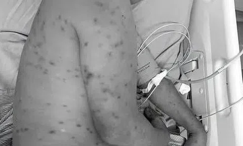 Bị hơn 300 con ong đốt, người đàn ông 62 tuổi nguy kịch