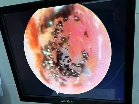 Bé 9 tuổi tai bị ngứa và chảy máu, đi khám phát hiện điều đáng sợ