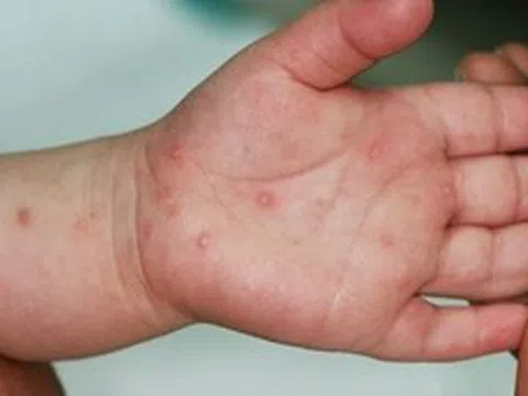 Bệnh tay chân miệng tại TP Hồ Chí Minh đang có dấu hiệu gia tăng trở lại