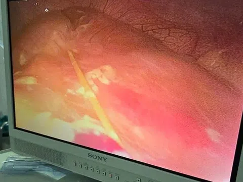 Nam thanh niên thủng ruột non do nuốt phải tăm tre