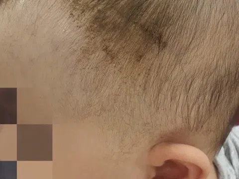Bé 7 tuổi chấn thương nặng sau cú ngã tưởng vô hại