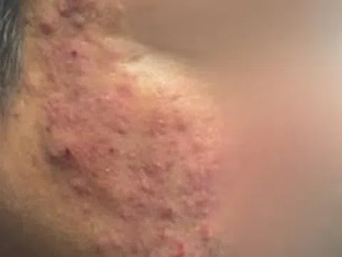 Tưởng mụn trứng cá, người đàn ông đi khám phát hiện "thủ phạm thầm lặng" gây bệnh