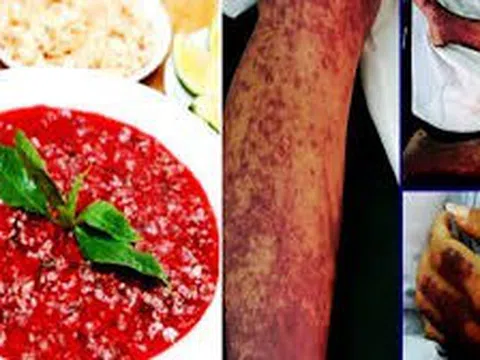 Ghi nhận các ca nhiễm bệnh liên cầu lợn gia tăng