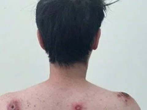 Bệnh giang mai gia tăng trở lại, cảnh báo nguy cơ ở nhóm quan hệ đồng giới