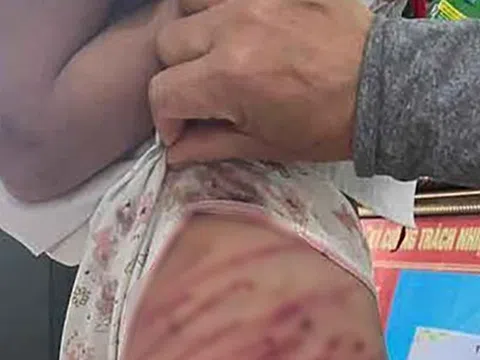 Hà Tĩnh: Xác minh vụ bé gái lớp 5 bị cha dượng bạo hành phải nhập viện