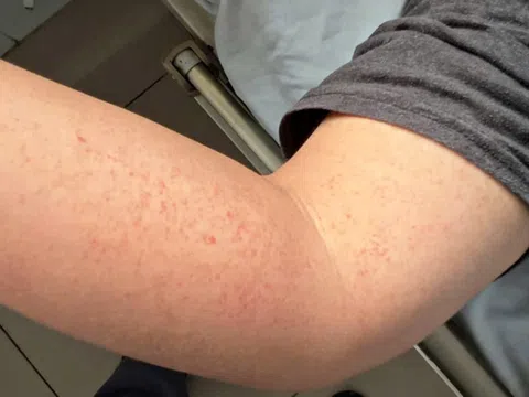 Bất kỳ ai cũng có thể mắc sốt xuất huyết và nguy cơ bệnh nặng