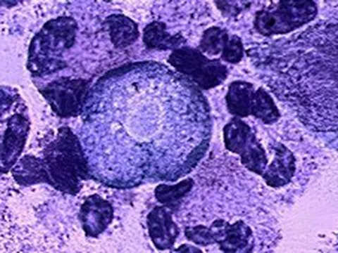 Tiểu bang Ấn Độ đối mặt với sự gia tăng số ca bệnh hiếm 'amip ăn não người'