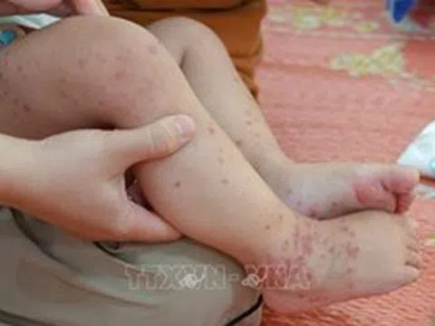 Vĩnh Long: Đảm bảo xử lý ổ dịch tay chân miệng trong vòng 48 giờ