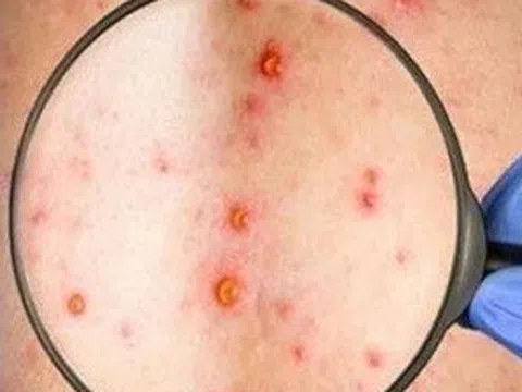 Đồng Nai ghi nhận ca mắc đậu mùa khỉ chưa rõ nguồn lây