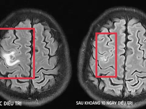 Cơn co giật bất thường hé lộ “vị khách lạ” ký sinh trong não