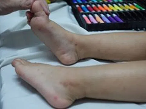 TP Hồ Chí Minh có 35.440 ca mắc tay chân miệng