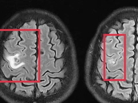 Người đàn ông 39 tuổi đau đầu, bác sĩ phát hiện thứ "đáng sợ" bên trong