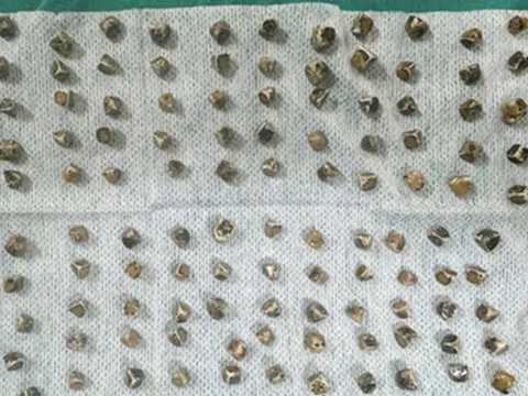 Đau bụng đi khám, người phụ nữ 40 tuổi sốc khi bác sĩ gắp ra thứ "đáng sợ" bên trong