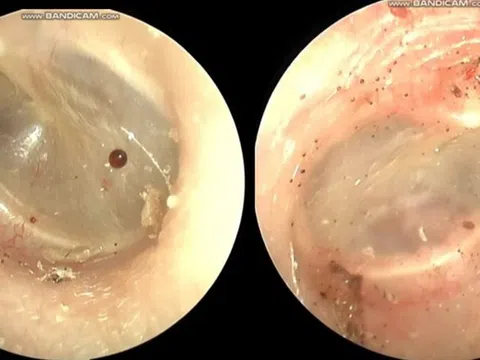 Người phụ nữ 60 tuổi tai ngứa như kim châm, bác sĩ gắp ra thứ "đáng sợ" bên trong