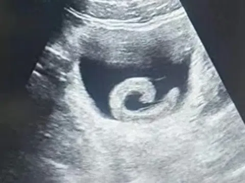 Đi siêu âm, người đàn ông sốc nặng khi thấy con vật "bơi" trong bụng mình