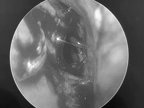 Đi khám, người đàn ông sốc nặng khi bác sĩ thấy thứ "đáng sợ" trong mũi mình