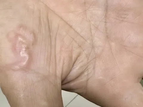 Thường xuyên ăn món "vạn người mê", cô gái trẻ sốc khi biết nhiễm 4 loại ký sinh trùng