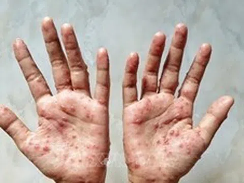 Malaysia xác nhận ổ bệnh đậu mùa khỉ mới