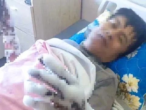 Bị phóng điện, người đàn ông bỏng nặng cả hai tay