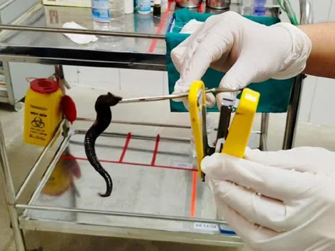 Đi khám, người đàn ông sốc nặng khi thấy thứ đáng sợ trong mũi mình