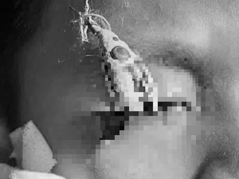 Bé trai 12 tuổi đau mắt dữ dội, bác sĩ gắp ra thứ "đáng sợ" bên trong