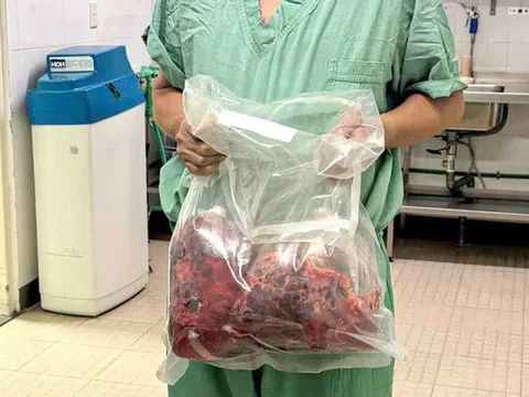 Lần đầu tiên tại Việt Nam: Cắt bỏ hai thận đa nang nặng gần 10kg, ghép thận thành công trong một ca mổ