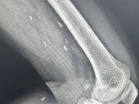 Thói quen nhiều người Việt mê mẩn khiến sán “làm tổ” dưới da mà không hay biết