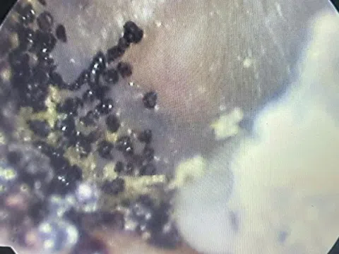 Nghe thấy âm thanh lạ trong tai, bé 7 tuổi đi khám thì sốc nặng