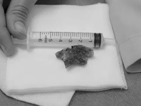 Nửa đêm đau họng, người phụ nữ 55 tuổi phát hiện bí mật "đáng sợ"