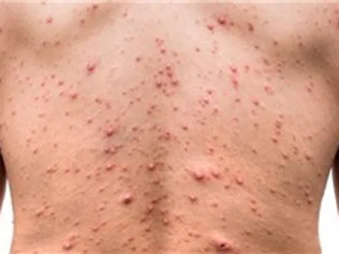 Giám sát, phát hiện sớm ổ dịch thủy đậu, không để lây lan trong cộng đồng
