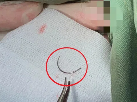 Kim khâu “mắc kẹt” suốt 11 năm trong cơ thể, người phụ nữ đến viện cầu cứu