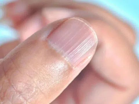 Móng tay nổi sọc dọc, cảnh báo dấu hiệu bất thường vấn đề sức khỏe