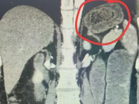 Người phụ nữ bụng "cứng như đá", bác sĩ sốc khi phát hiện bí mật "đáng sợ"