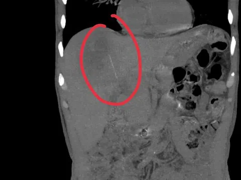 Người đàn ông đau bụng kéo dài, bác sĩ sốc khi phát hiện bí mật bên trong