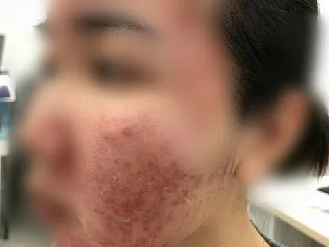 Cơn ác mộng của thiếu nữ chỉ sau vài giờ được mời làm đẹp cấp tốc đón Tết