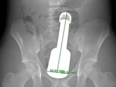 Nam thanh niên 15 tuổi nhập viện vì đau bụng dữ dội, bác sĩ sốc khi phát hiện thứ “đáng sợ” bên trong