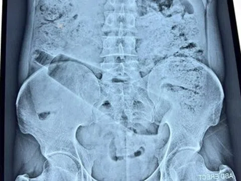 Người đàn ông đau bụng 36 tiếng, bác sĩ phát hiện "bí mật" bên trong