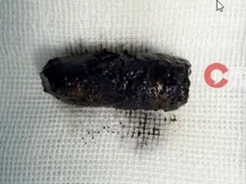 Mũi người đàn ông chảy dịch dai dẳng, bác sĩ phát hiện bí mật đáng sợ