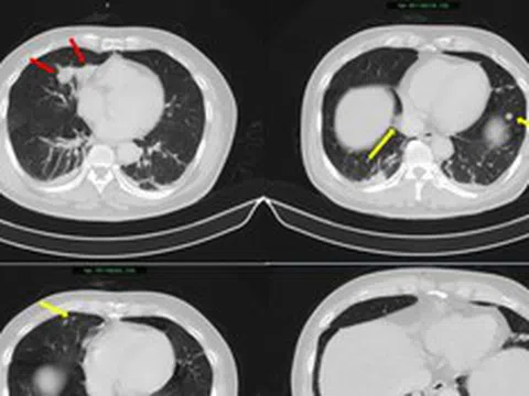 Người đàn ông 63 tuổi sốc nặng khi phát hiện mắc hai bệnh ung thư cùng lúc