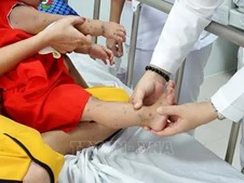 Tây Ninh: Bệnh tay chân miệng tăng 2,5 lần